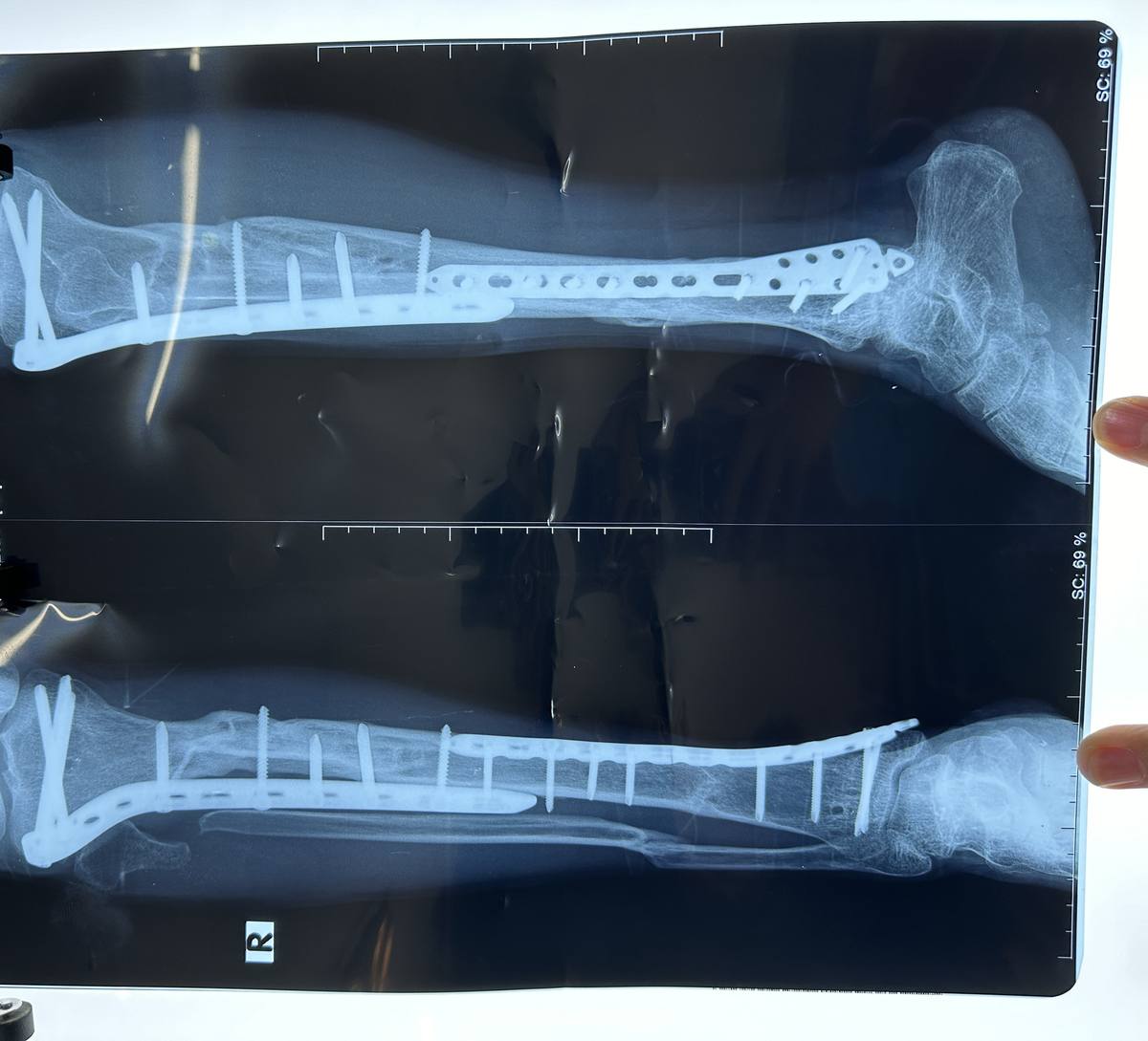 X-ray